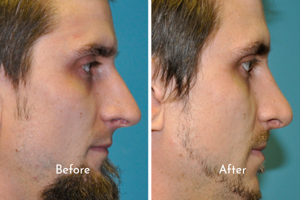 Profile images of man before and after rhinoplasty surgery