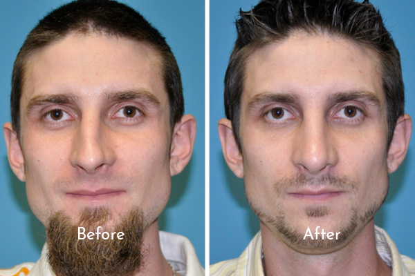 Portrait of man before and after rhinoplasty