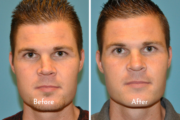 Portrait images of man before and after rhinoplasty