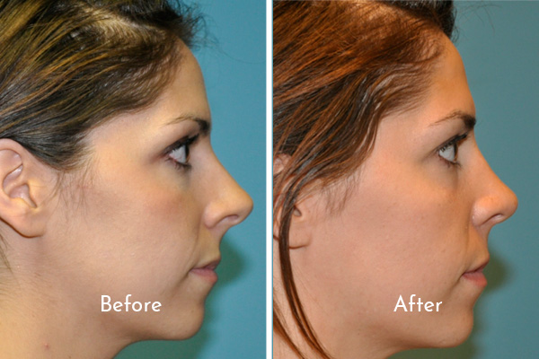 Profile images of woman before and after rhinoplasty