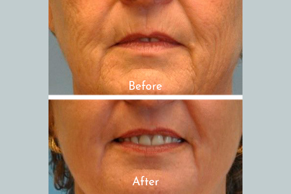 Chin before and after skin treatment