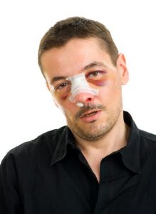 man with broken nose