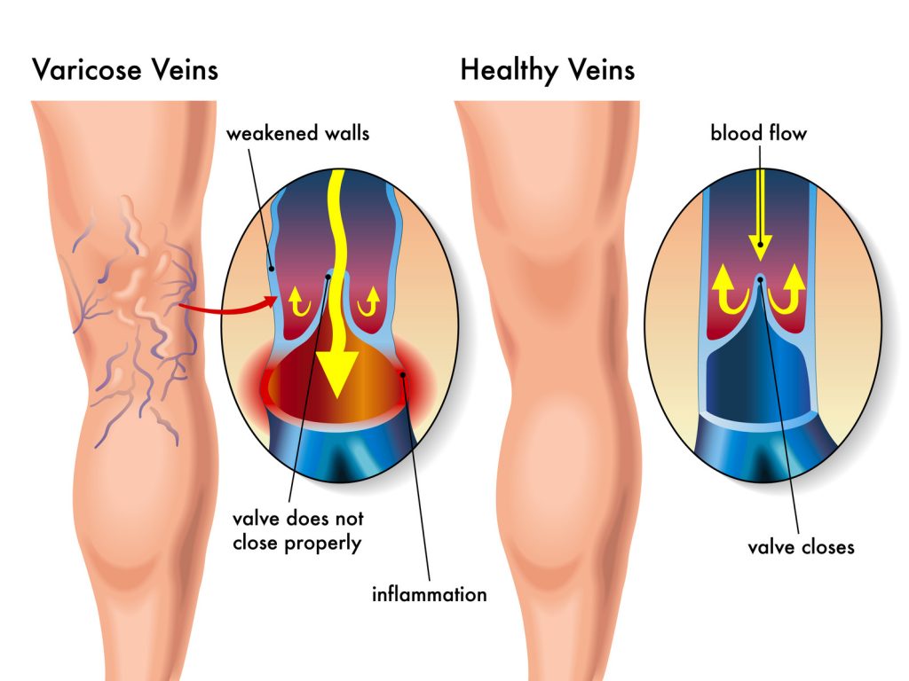 Varicose Veins Graphic