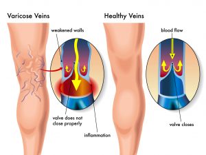 Varicose Veins Graphic