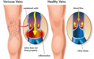 Varicose Veins Graphic