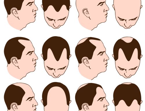 Pattern Hair Loss: Common Questions Answered
