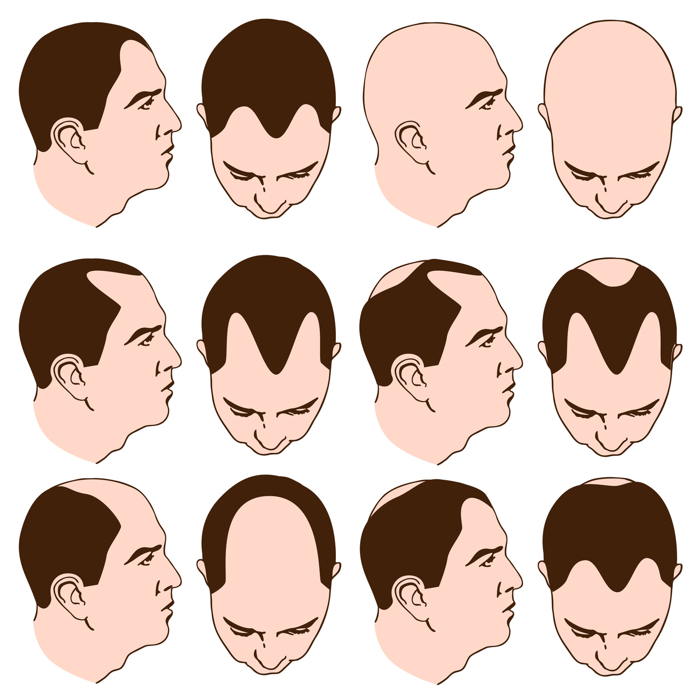 Pattern Hair Loss: Common Questions Answered | Barr Aesthetics