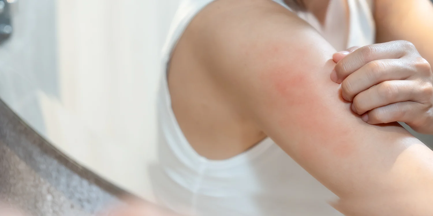 irritated skin on a woman's upper arm