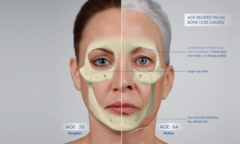 chart of Age-related facial bone loss