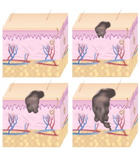 Skin cancer diagram