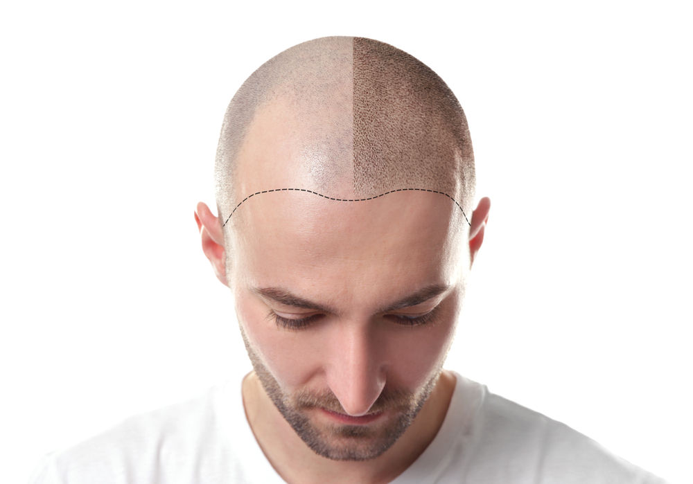 Man looking down with hair line drawn on shaved head