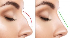 open nose surgery reshaping