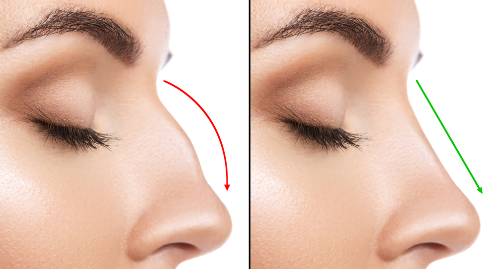 Depiction of nose before and after nose surgery