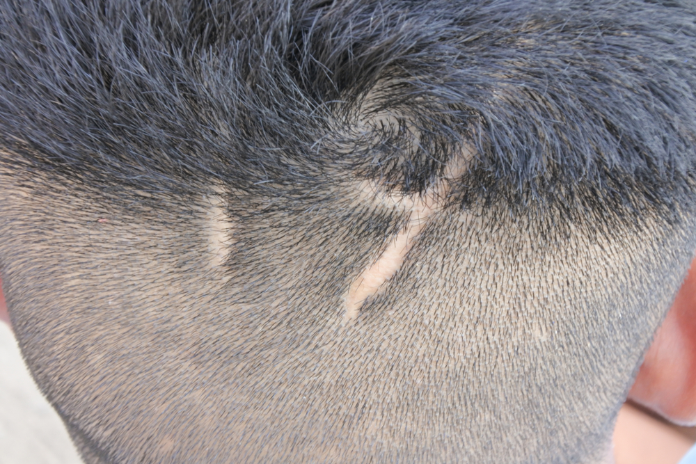 Close up of scars on a man's scalp