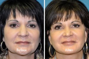 face lift before and after