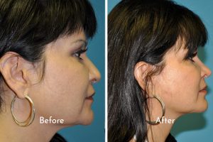 face lift before and after