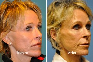 Before and after facial fat grafting from Barr