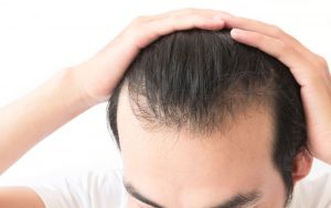 Man holding hair back to show thinning hairline.