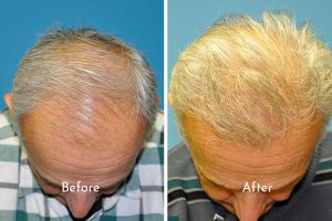 Male Hair restoration before and after