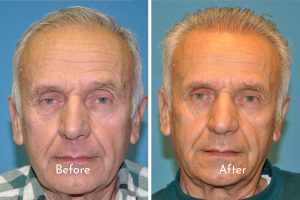 Male Hair restoration before and after