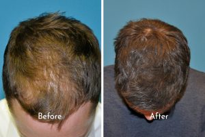 Male Hair restoration before and after