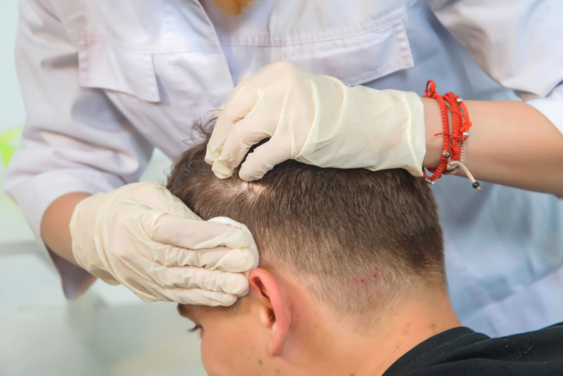About Men's Hair Loss | Utah Hair Transplants | Barr Aesthetics