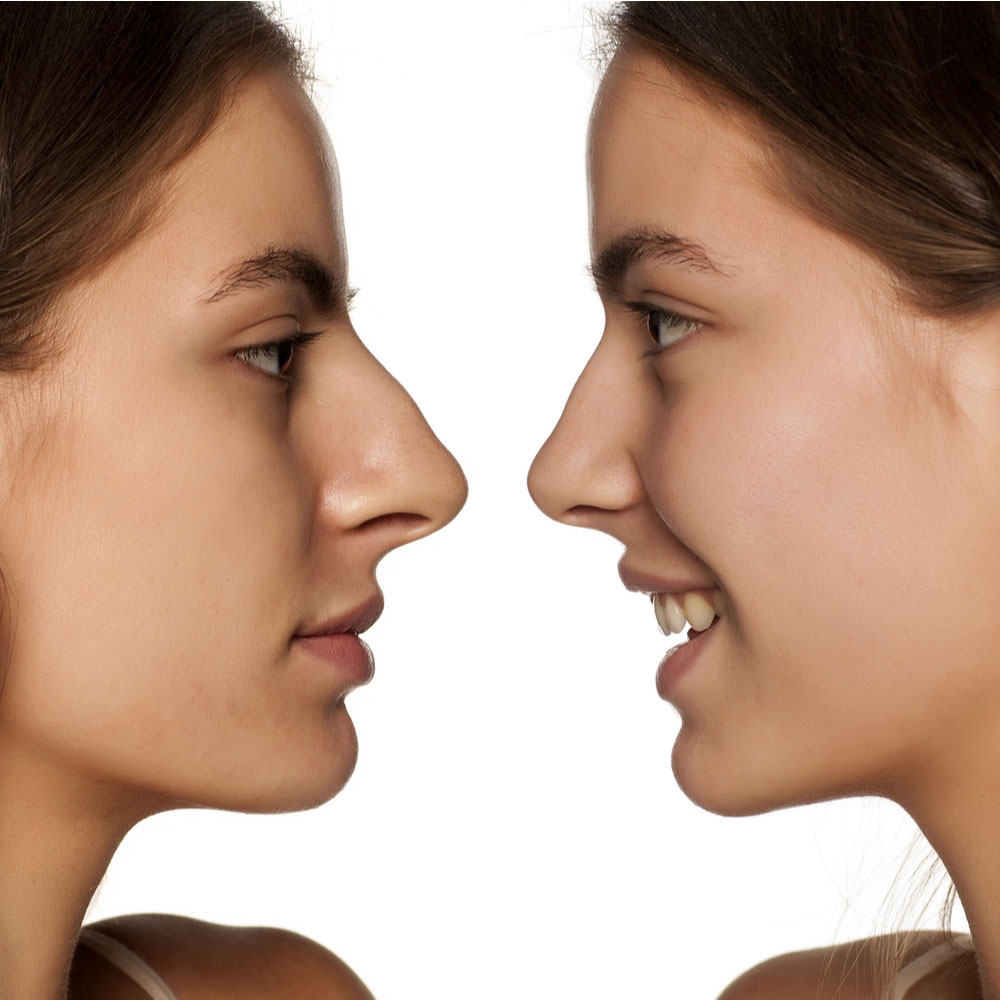 Before and after images of closed rhinoplasty, showing a reduced bump on the nose.