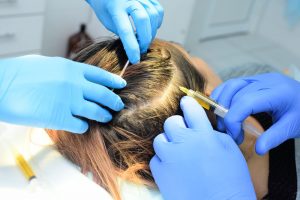 PRP Hair Loss Treatment