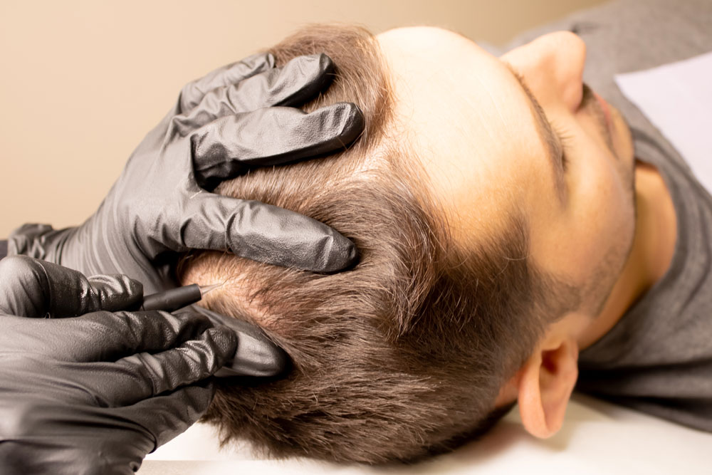 Man receiving hair restoration SMP procedure