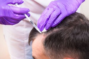 PRP Hair loss treatment