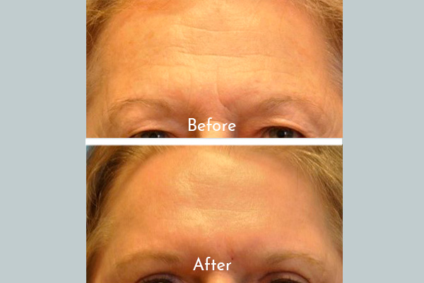 forehead before and after skin treatment