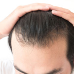 man pulling his hair back to reveal hairline
