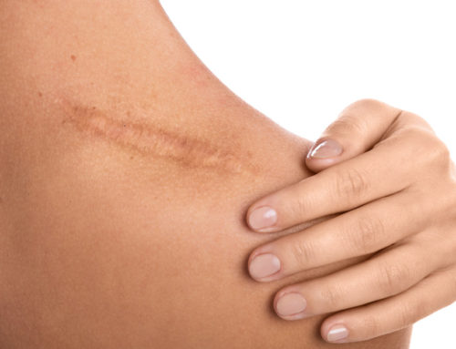 Why Do We Scar (And Are They Permanent)?
