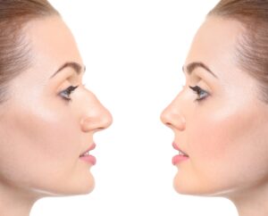 a woman before and after rhinoplasty