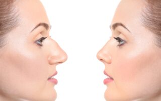 a woman before and after rhinoplasty