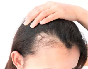 Woman with hair loss