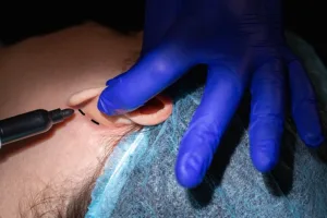 marking lines behind the ear for a surgical procedure