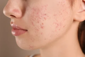 Laser acne treatment