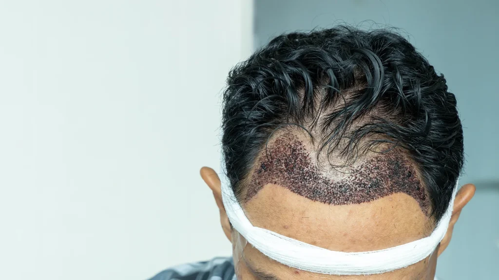 hair transplant