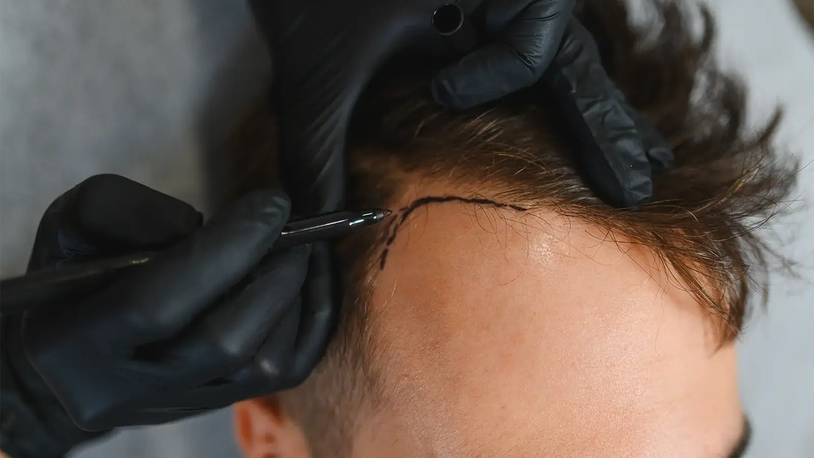 Utah hair replacement services showing a male's scalp being marked during a consultation